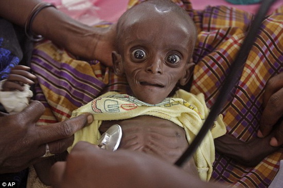 Bé Mihag Gedi Farah mới 7 tháng tuổi mà trông bé chẳng khác gì một ông lão.