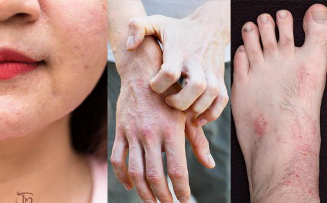 Ngứa da c� thể l� biểu hiện của nhiều bệnh.