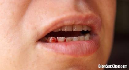 nhung dau hieu chung to ban dang mac benh nguy hiem cbff17 Triệu chứng đột quỵ v� nhiều bệnh nguy hiểm xảy ra h�ng ng�y