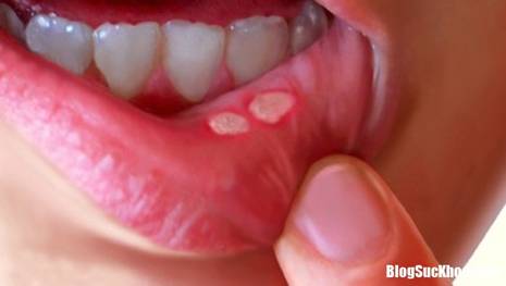 1 1555172939 872 width700height396 B�i thuốc chữa nhiệt miệng nhanh v� ph� hợp với nhiều đối tượng