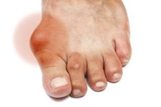 cach chua benh gout bang rau tia to 1104744 C�ng dụng chữa bệnh gout của l� t�a t�